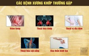 Một số bệnh về xương khớp thường gặp