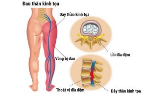 Đau thần kinh tọa: Dấu hiệu, nguyên nhân, điều trị, dự phòng