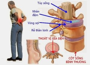 Thoát vị đĩa đệm - Nguyên nhân, triệu chứng, cách điều trị, khắc phục