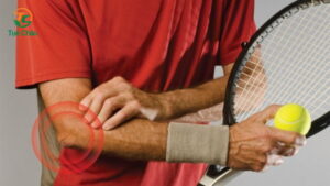 Hội chứng Tennis Elbow dẫn tới viêm gân