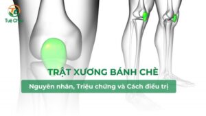 Trật xương bánh chè: nguyên nhân, dấu hiệu, chẩn đoán và điều trị